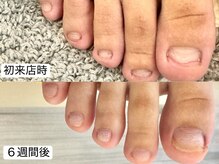 深爪矯正 爪悩み専門店 cocomo/(深爪/長さだし/フィルイン)