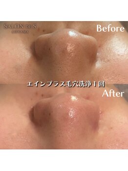 サロン ド エス アオヤマ(SALON DE S AOYAMA)/毛穴徹底ケアで毛穴レス肌に!