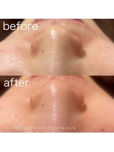 ルルラ リコ(lulula rico)/症例写真/ハイドラ毛穴洗浄