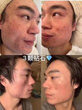 ステップイン(Step in)/ダイヤモンドピールプログラム