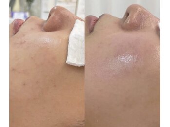 エクスクラメーションマーク(!!!)/肌質改善♪