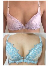 ソラ(SORA)/バストアップ症例