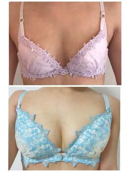 ソラ(SORA)/バストアップ症例