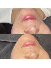 セレーノ(seReno)/炭酸パック/カーボキシー