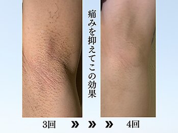 アンジェリーナ/メンズ フラッシュ脱毛/脇毛