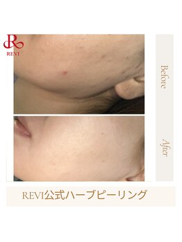 ルヴィショップ 沖縄(REVI SHOP)/韓国アイドル級の美肌へ