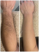 リリールア(Rere-Rua)/メンズ脱毛大人気♪