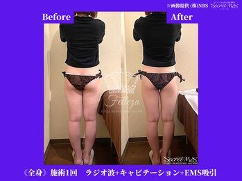 フェレザ 新潟(Felleza)/キャビテーション