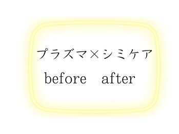 ラビエス(LAVIES)/結果重視プラズマ/シミケア