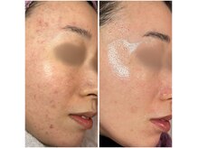 ディンプル(Dimple)の雰囲気（その方に合ったベストな改善法をお伝えします。）