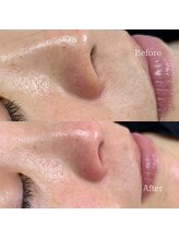 サーラ(SA-RA)/鼻下ワックス