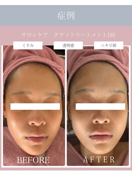 エクラフルール(Eclat Fleur)の写真/タラソトリートメント￥11,000　紫外線や加齢によるシミにお悩みの方におすすめ。ニキビなどの肌悩みにも◎