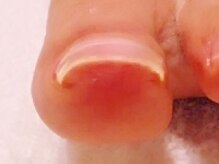 ティアラリュクス 東林間店(Tiara Luxe)/巻き爪矯正　BSブレイス/After