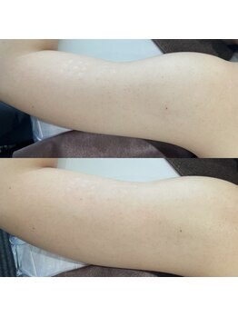 ウルル(ULuLu)/二の腕の肌トラブル改善!