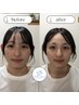 【初回限定】個体調律美容鍼＋小顔矯正《1回¥11,000→2回¥15,000》