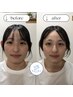 【2回クーポン】美容鍼(むくみとり、引き締め)＋小顔矯正《¥22000→¥18800》