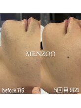 メンズー(MENZOO)/ヒゲ脱毛