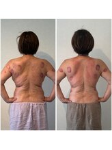 ビレイ(Birei)/カッサ＋カッピング