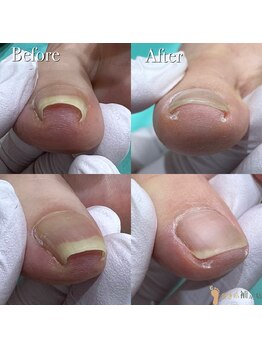 巻き爪補正店 那覇店/