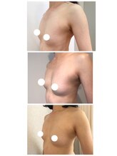 ラディス(Radice.)/【バストアップ症例】