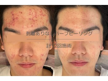 ライフ美容整体院 恵比寿(Life美容整体院)/ハーブピーリングでニキビケア◎
