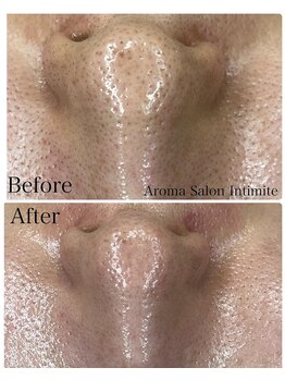 アンティミテ(Intimite)/毛穴洗浄1回の変化