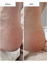 ケアプラス(care plus)/足裏角質ケア