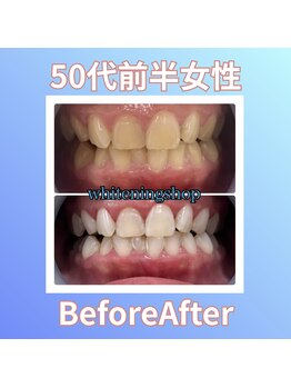 ホワイトニングショップ 西原店/50代前半女性☆BeforeAfter