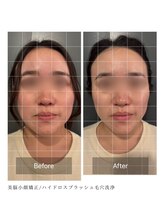 ルフレ 心斎橋(Reflet)/小顔矯正&毛穴洗浄　BeforeAfter
