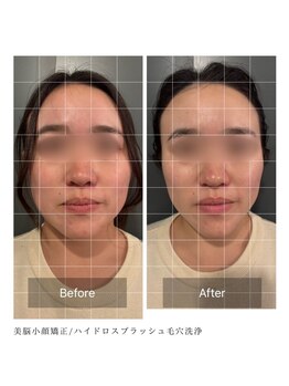 ルフレ 心斎橋(Reflet)/小顔矯正&毛穴洗浄 BeforeAfter
