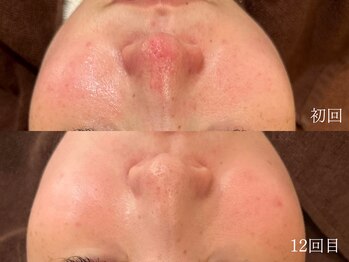 ウォーム(warm)/毛穴/毛穴洗浄/毛穴ケア/毛穴