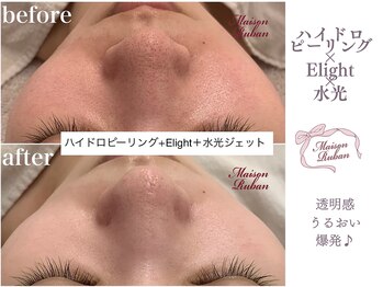 メゾンリュバン 梅田店(Maison Ruban)/毛穴洗浄・美白フォト|美白ケア