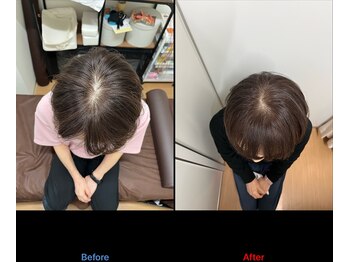 松尾美容鍼灸×整体 香椎/育毛促進美髪鍼