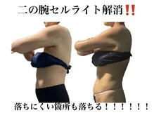 痩身革命 大宮店/施術写真（痩身）