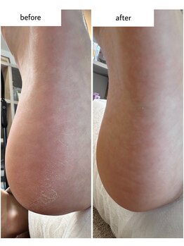 ケアプラス(care plus)/足裏角質ケア