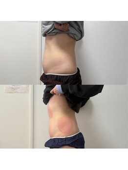 ミージュ(Miiju.)/お腹ぺったんこ脂肪冷却4カップ