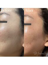 マベル シュガーリング(Mabelle)/お顔脱毛