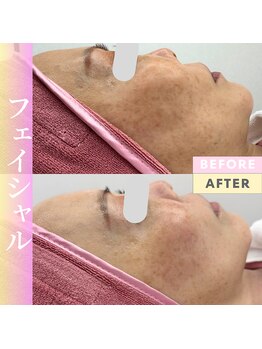 Cスキンケアクリニック 麻布店/ハイドラ＋光フェイシャル