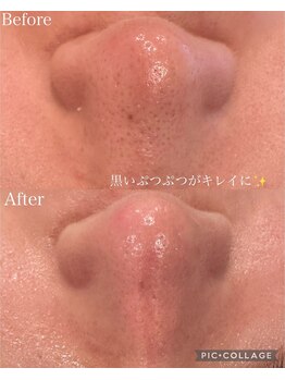 ウォーム(Warm)/30代　毛穴エクストラクション