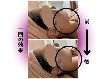 カリアンヌ/小顔/リフトアップフェイシャル