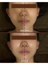 漢方アロマヒーリングサロン 浦和店(漢方AROMAヒーリングサロン)/ハイパーナイフ７★フェイシャル