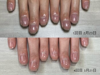 自爪育成3ヵ月コース