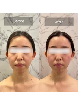 ブレスト サロン 奈良店(Bryst Salon)/小顔フェイシャル症例