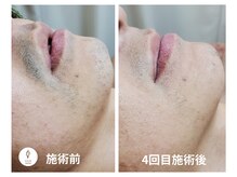 ヴォアール 名古屋店(VOIR)/メンズ脱毛　ヒゲ脱毛＋VIO脱毛