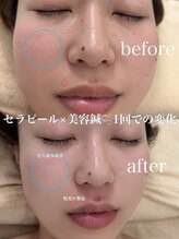 アキュモンド 渋谷院(acumond)/セラピール施術1回での変化