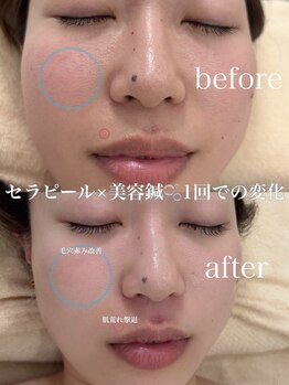 アキュモンド 渋谷院(acumond)/セラピール施術1回での変化