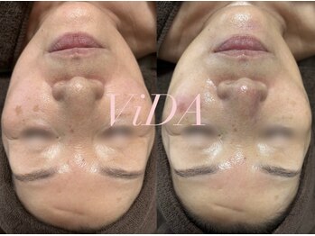 ヴィーダ 渋谷松濤(ViDA)/ハイドラ・高出力プラズマ