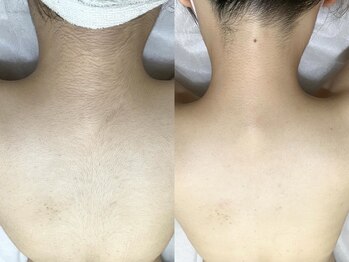 エリクサー 加須店(Elixir)/女の子の脱毛も大歓迎!