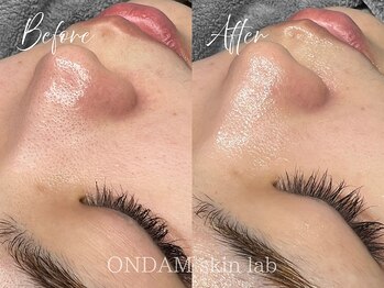 オンダム 南青山 表参道(ONDAM)/【毛穴の詰まり・開き】
