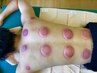利用者多数!!! ★☆カッピング/吸角☆★通常6,980円⇒4,980円